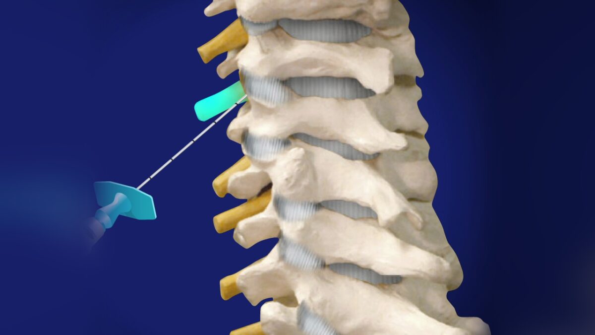 Selective Nerve Root Block